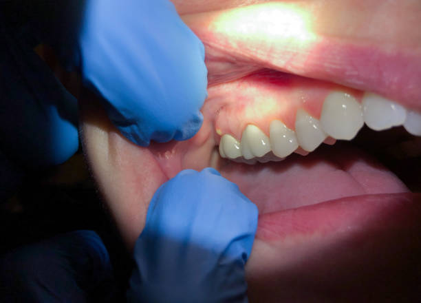 Best Emergency Dental Care for Broken or Chipped Teeth in Otis Orchards East Farms, WA